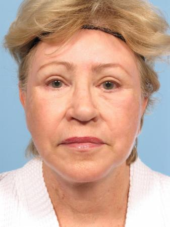 Facelift: Patient 1 - After Image 1