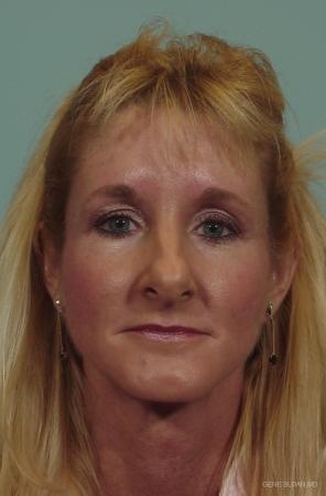 Rhinoplasty: Patient 2 - Before Image 1