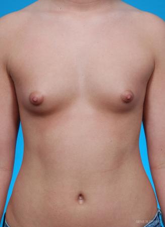 Breast Augmentation: Patient 18 - Before Image 1