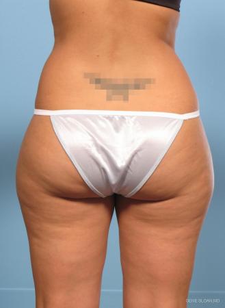 Liposuction: Patient 1 - Before and After Image 2