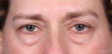 Blepharoplasty: Patient 1 - Before Image