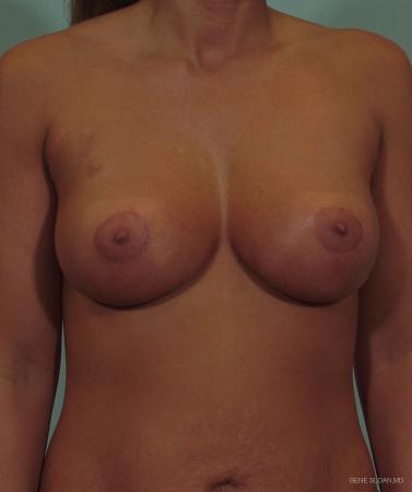 Breast Lift: Patient 5 - After Image 1
