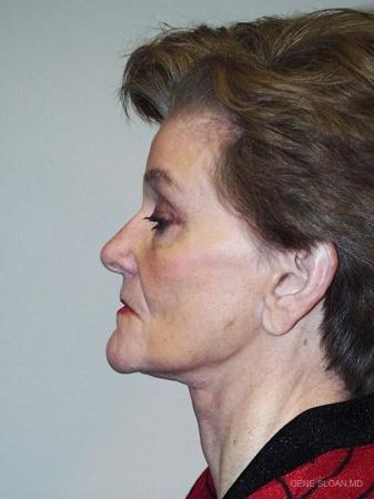 Facelift: Patient 3 - After Image 2