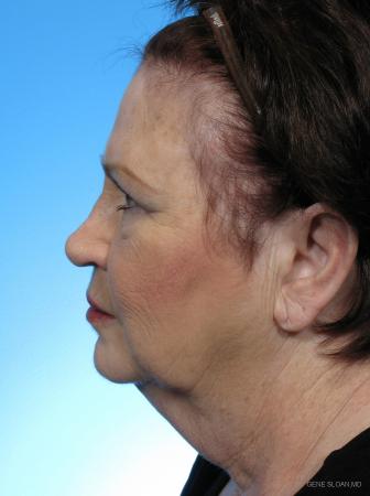 Facelift: Patient 1 - Before and After Image 2