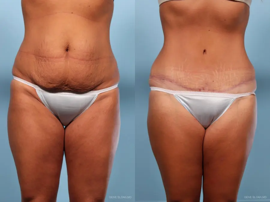Abdominoplasty: Patient 1 - Before and After 1