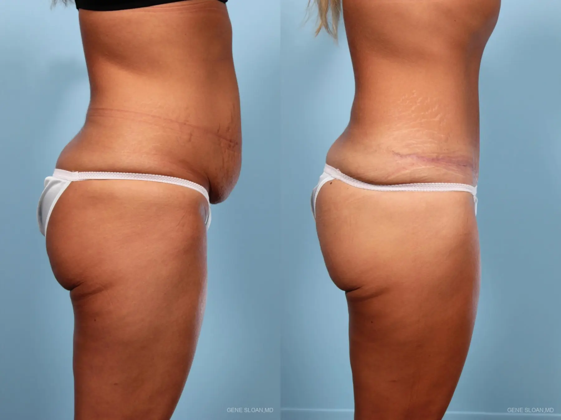 Abdominoplasty: Patient 1 - Before and After 2