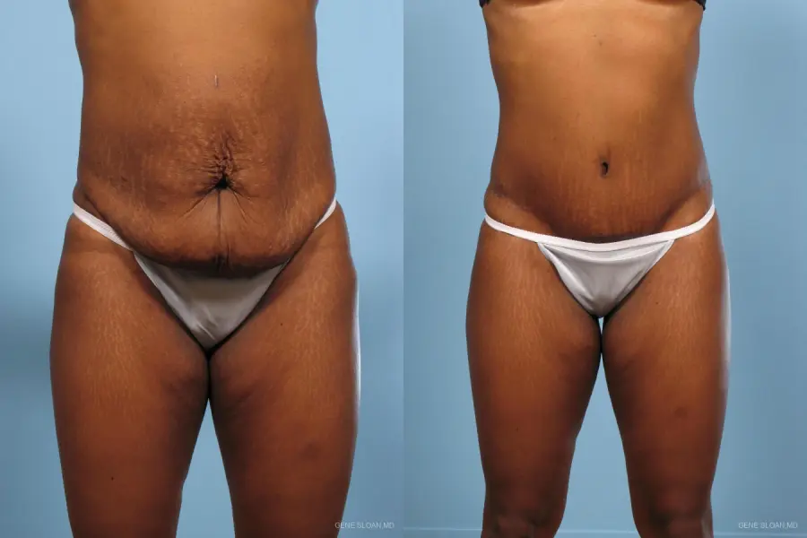 Abdominoplasty: Patient 2 - Before and After 1