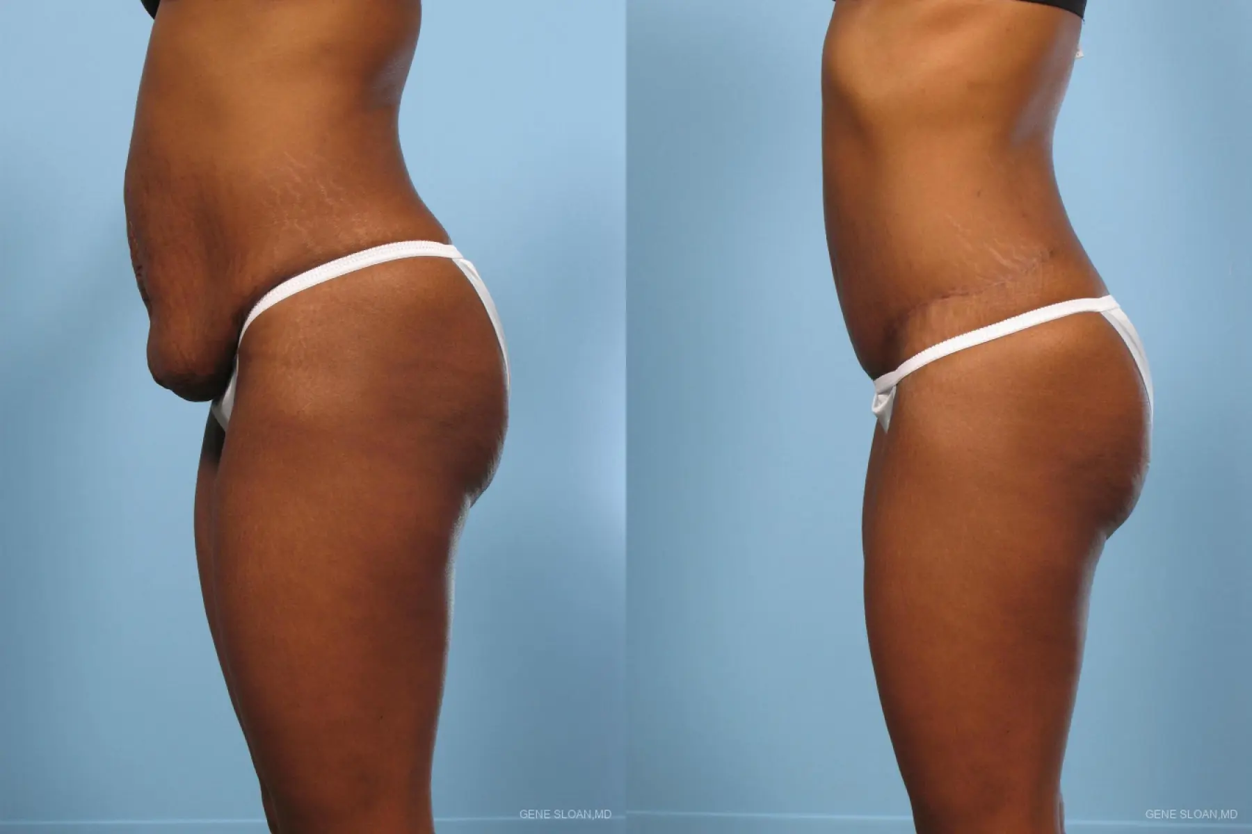 Abdominoplasty: Patient 2 - Before and After 2