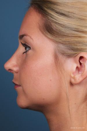 Rhinoplasty: Patient 7 - After Image 2