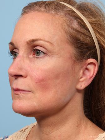 Facelift: Patient 7 - After Image 2