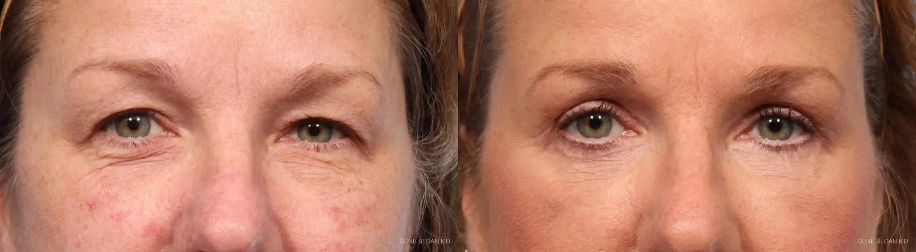 Blepharoplasty: Patient 6 - Before and After 1