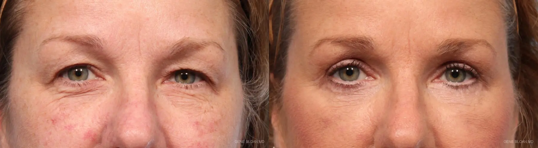 Blepharoplasty: Patient 6 - Before and After