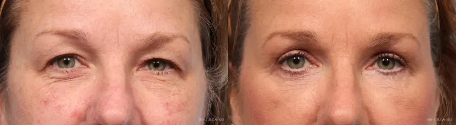Blepharoplasty: Patient 6 - Before and After 1