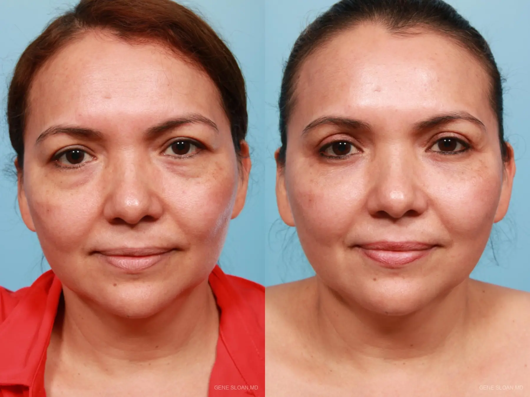 Blepharoplasty: Patient 10 - Before and After  