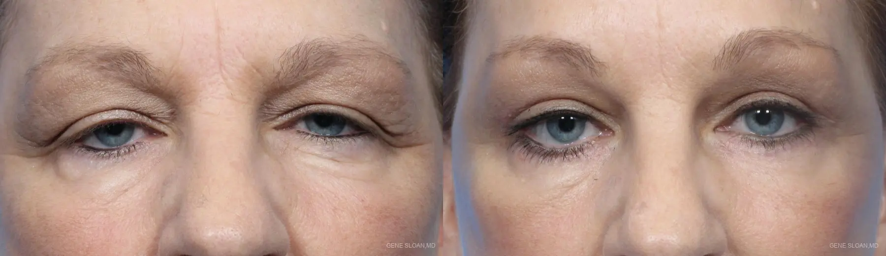 Blepharoplasty: Patient 7 - Before and After