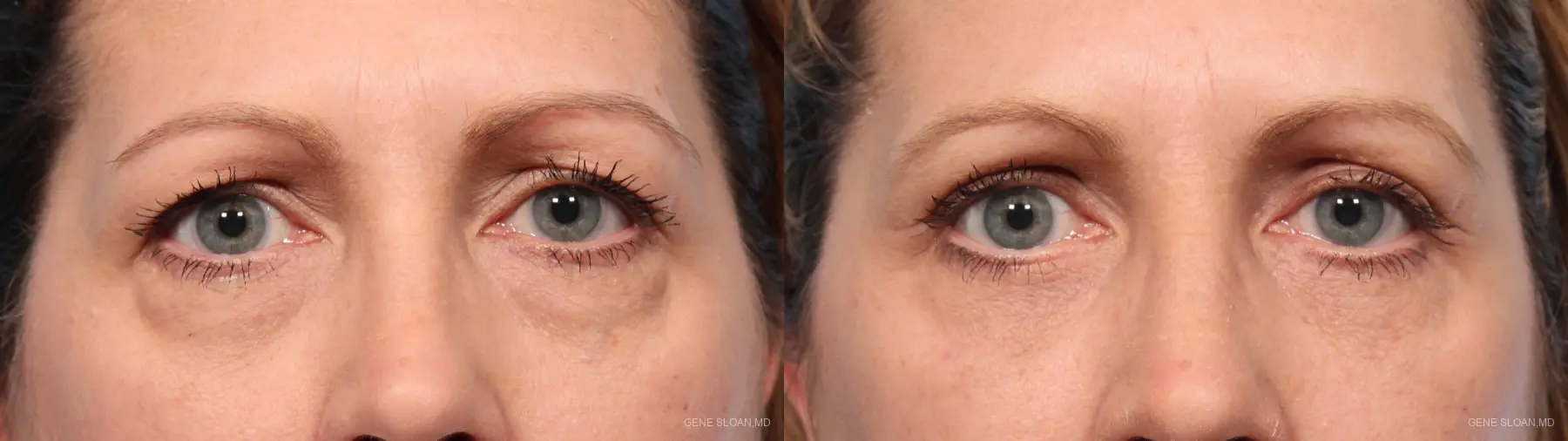 Blepharoplasty: Patient 9 - Before and After