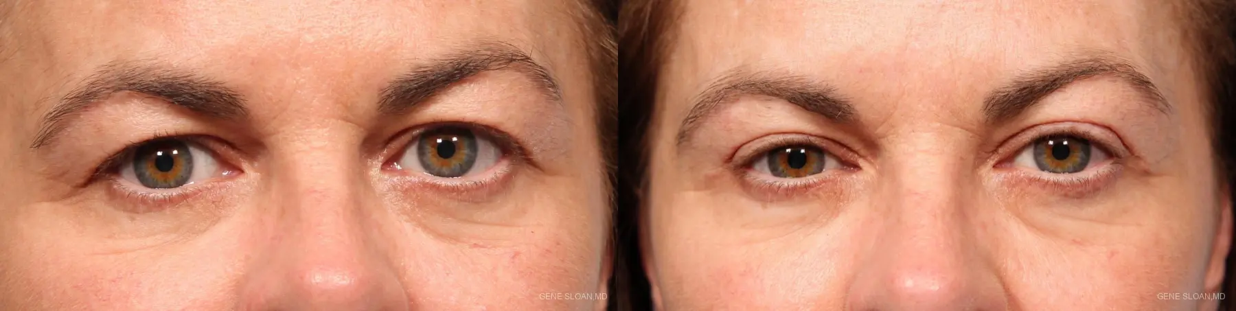 Blepharoplasty: Patient 4 - Before and After