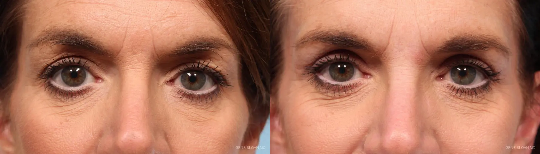 Blepharoplasty: Patient 2 - Before and After