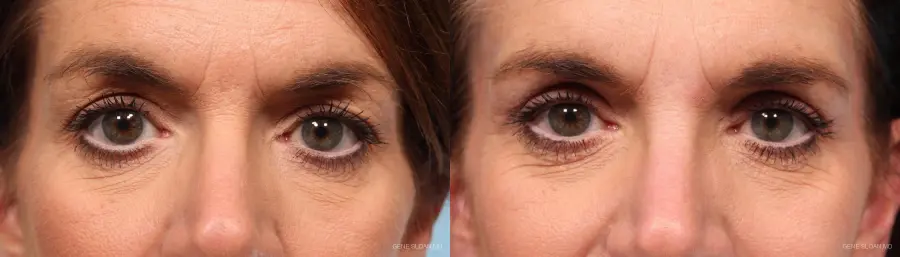 Blepharoplasty: Patient 2 - Before and After 1