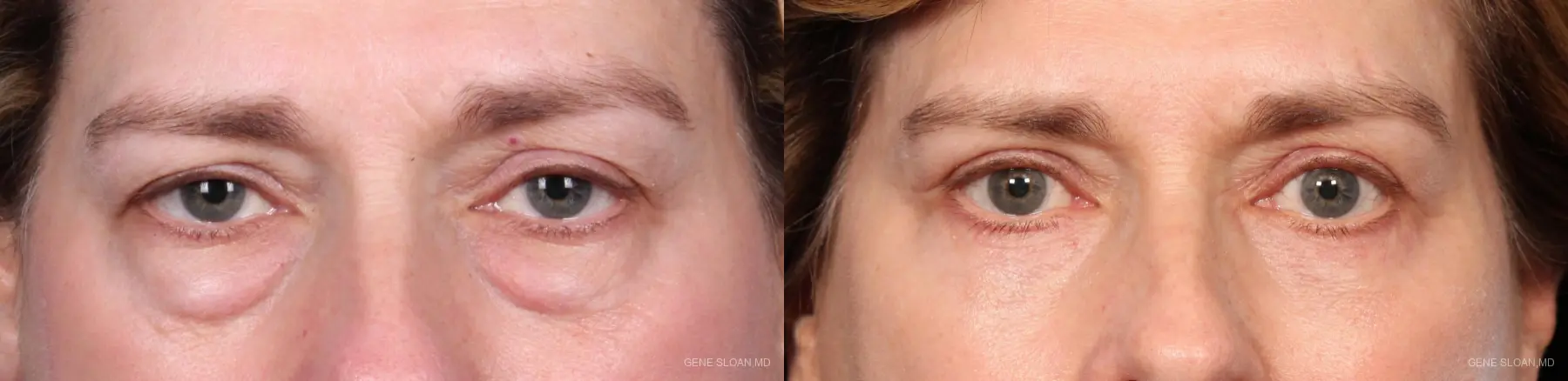 Blepharoplasty: Patient 1 - Before and After