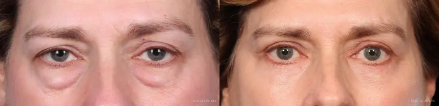 Blepharoplasty: Patient 1 - Before and After 1
