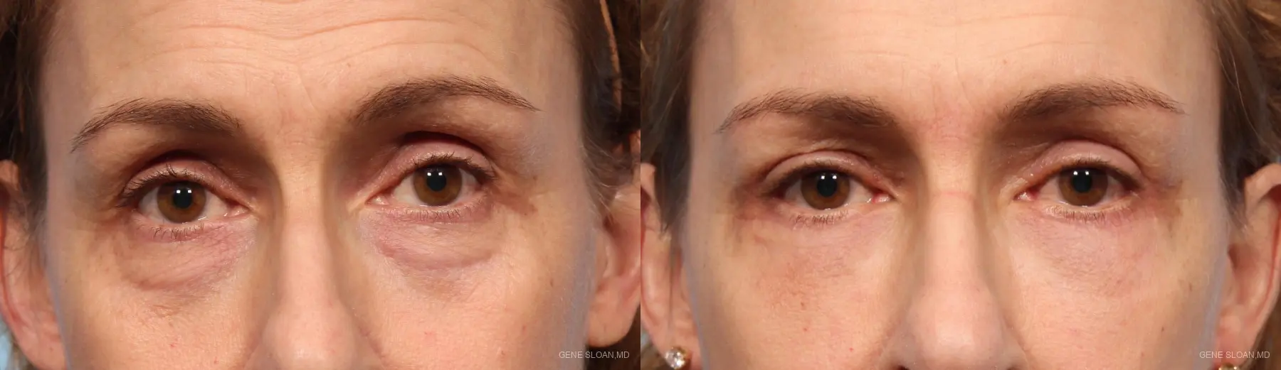 Blepharoplasty: Patient 8 - Before and After