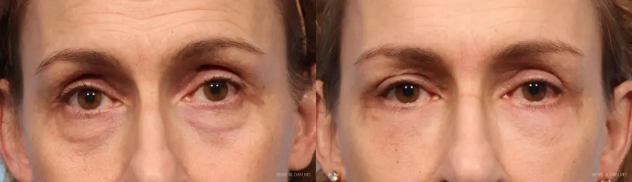 Blepharoplasty: Patient 8 - Before and After 1