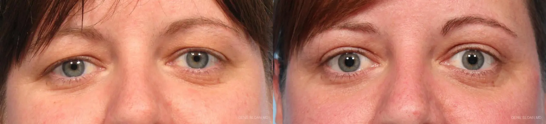 Blepharoplasty: Patient 5 - Before and After