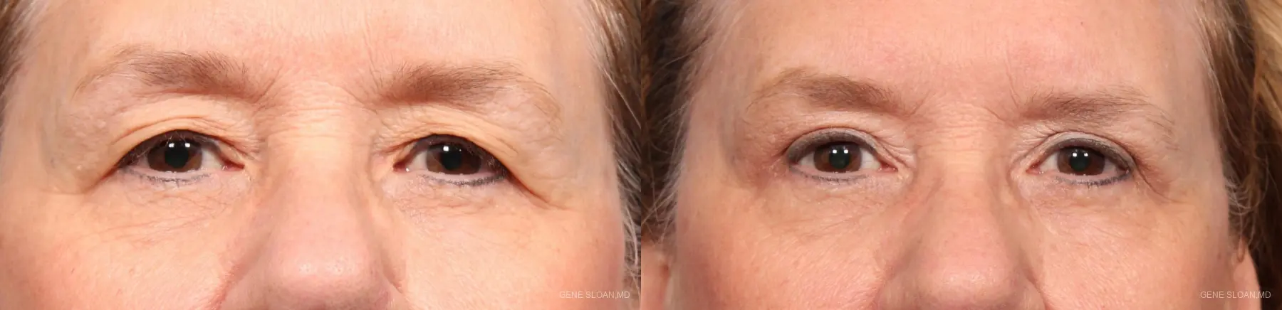 Blepharoplasty: Patient 3 - Before and After 1