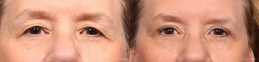 Blepharoplasty: Patient 3 - Before and After 1