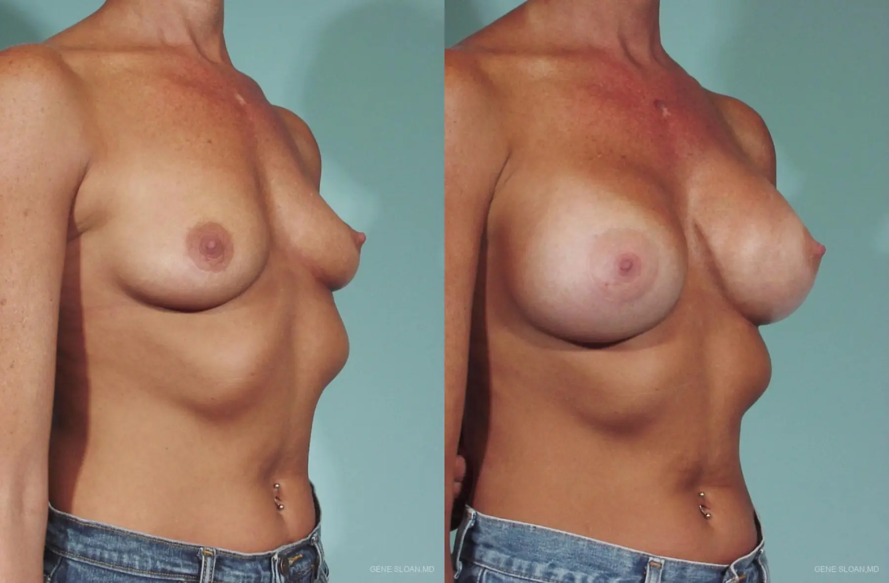 Breast Augmentation: Patient 21 - Before and After 2