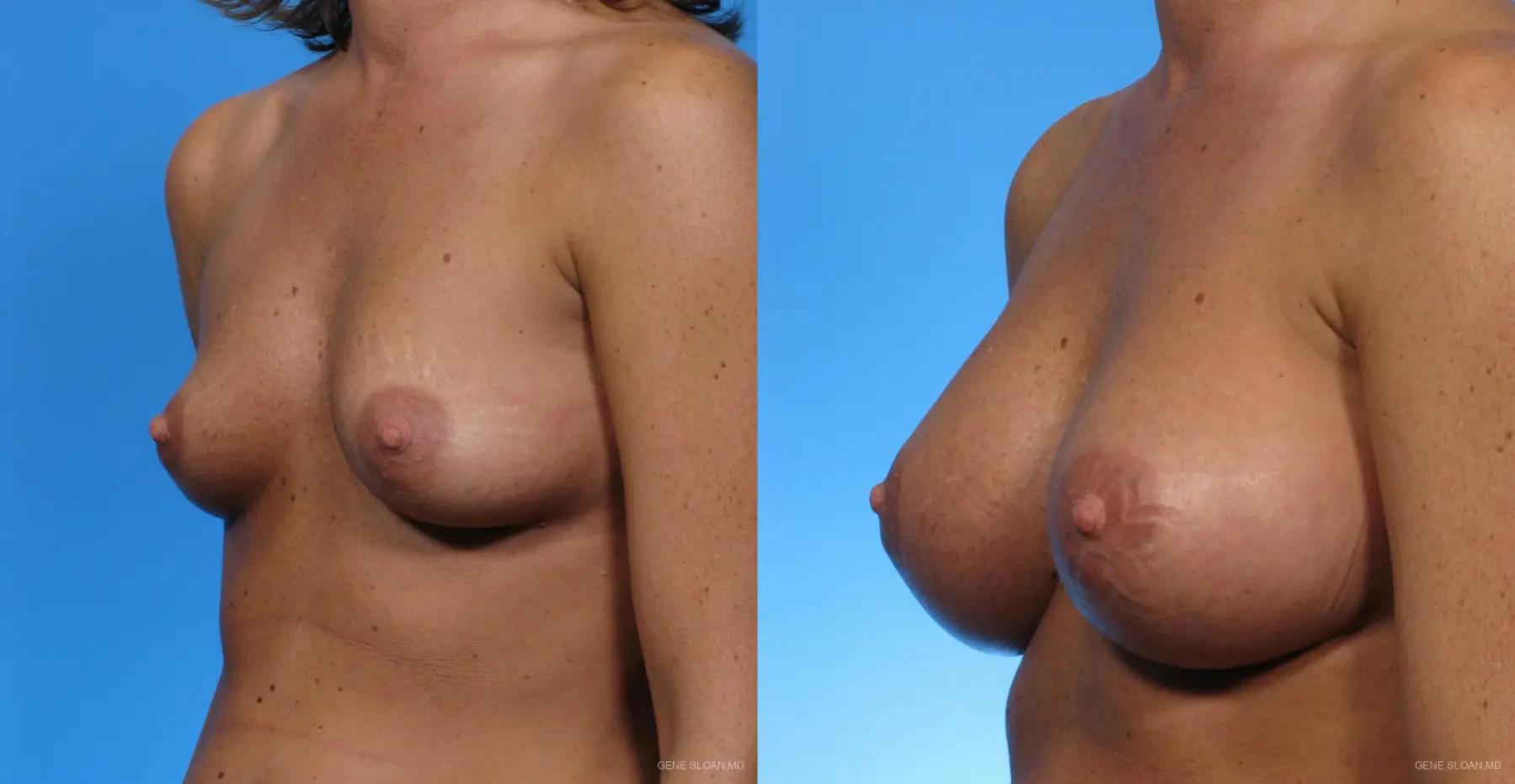 Breast Augmentation: Patient 2 - Before and After 2