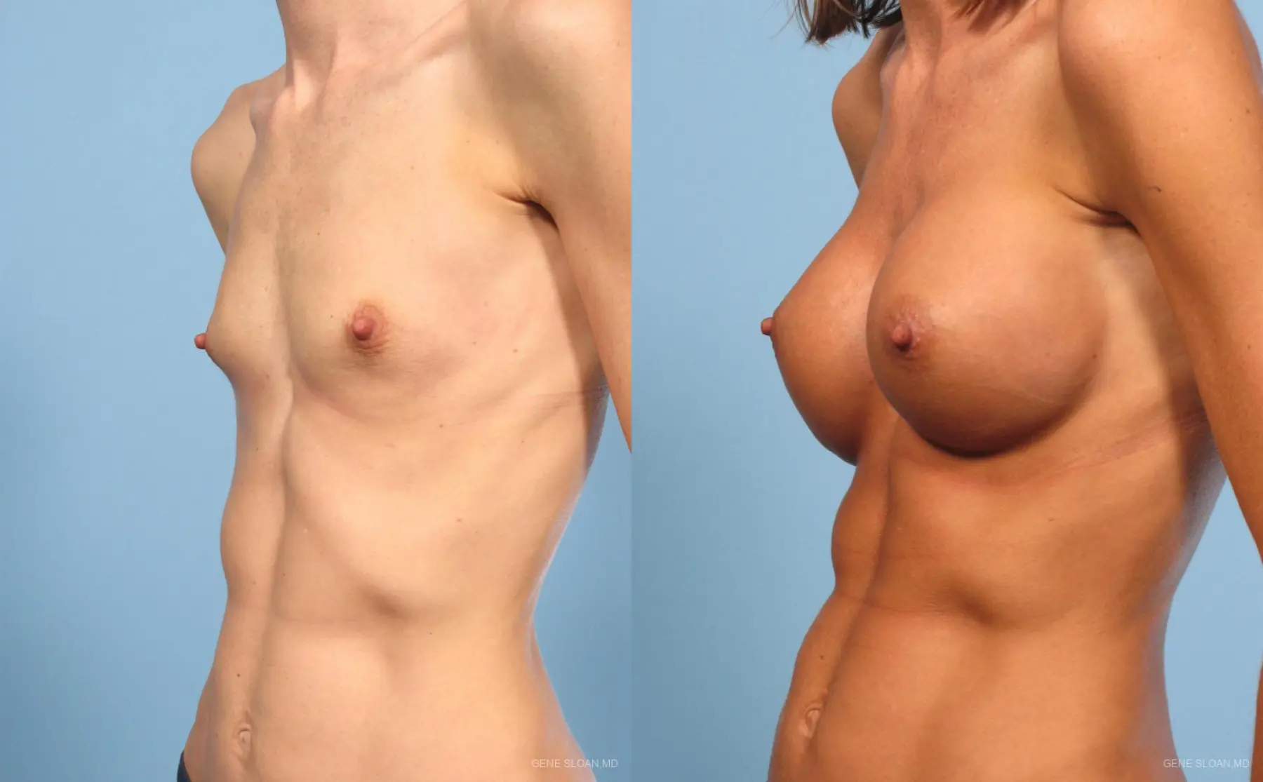 Breast Augmentation: Patient 9 - Before and After 2