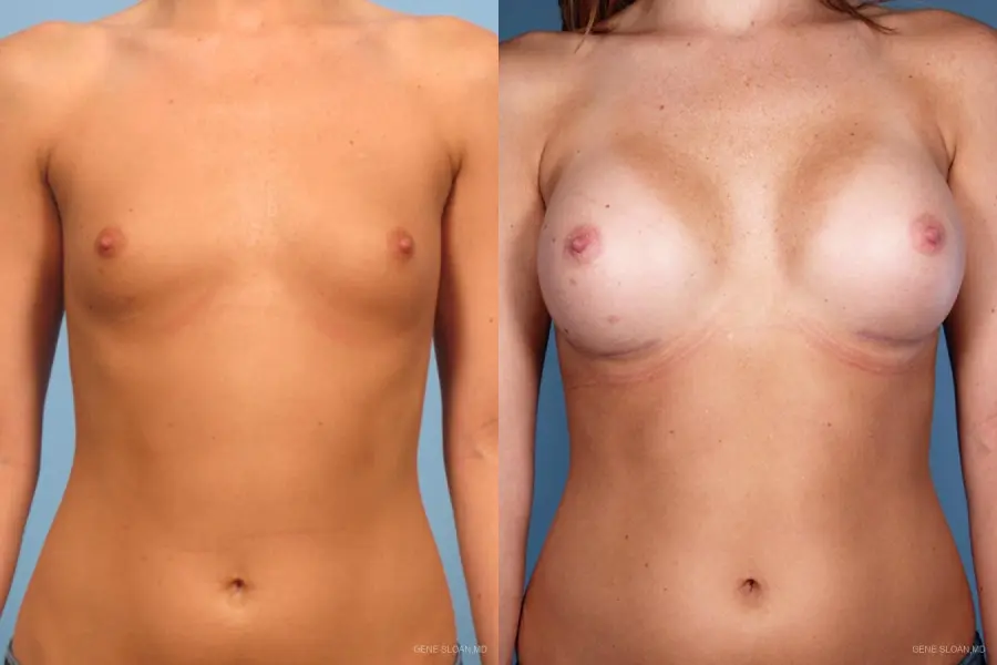 Breast Augmentation: Patient 14 - Before and After 1