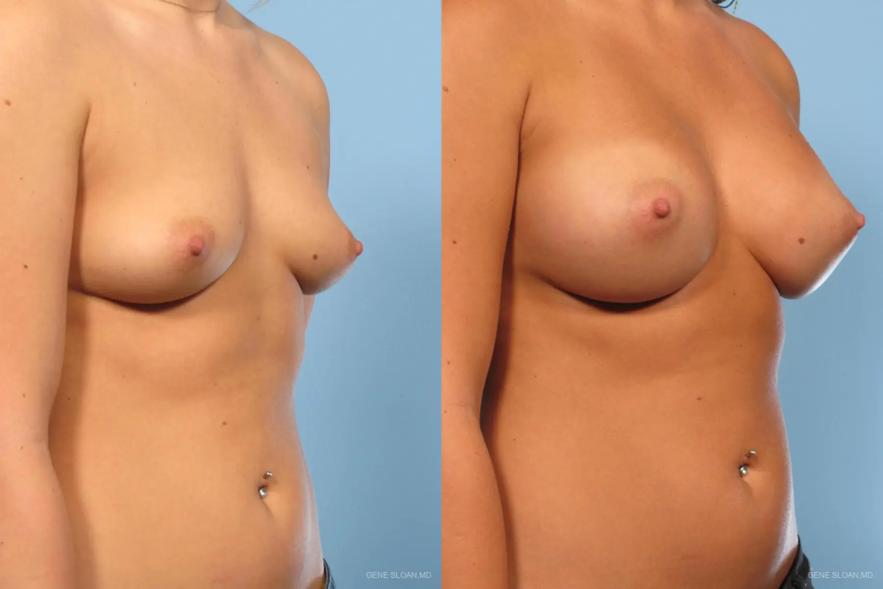 Breast Augmentation: Patient 3 - Before and After 2