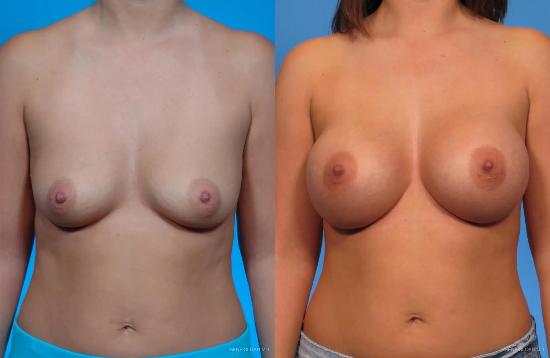 Breast Augmentation: Patient 1 - Before and After 1