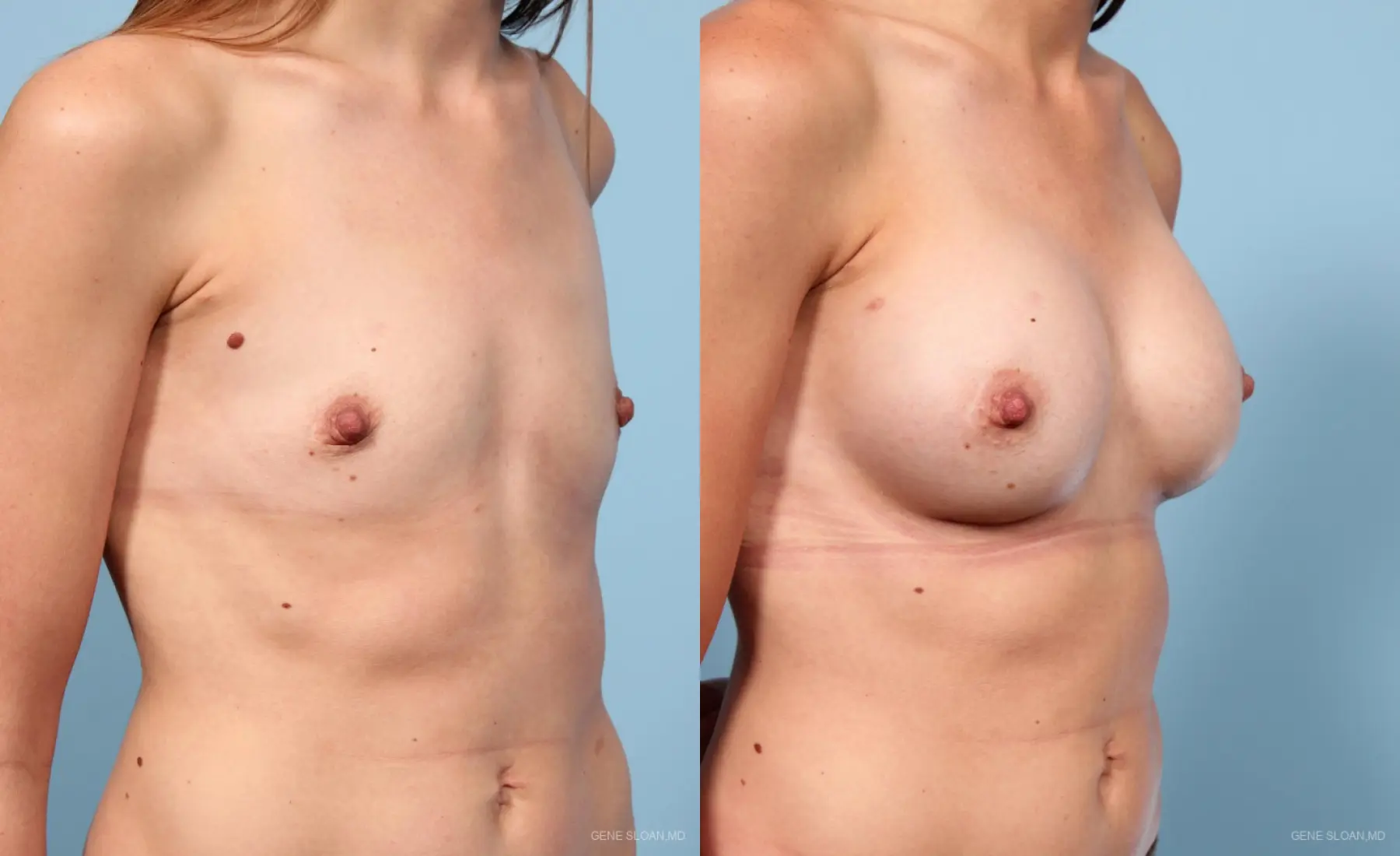 Breast Augmentation: Patient 19 - Before and After 2
