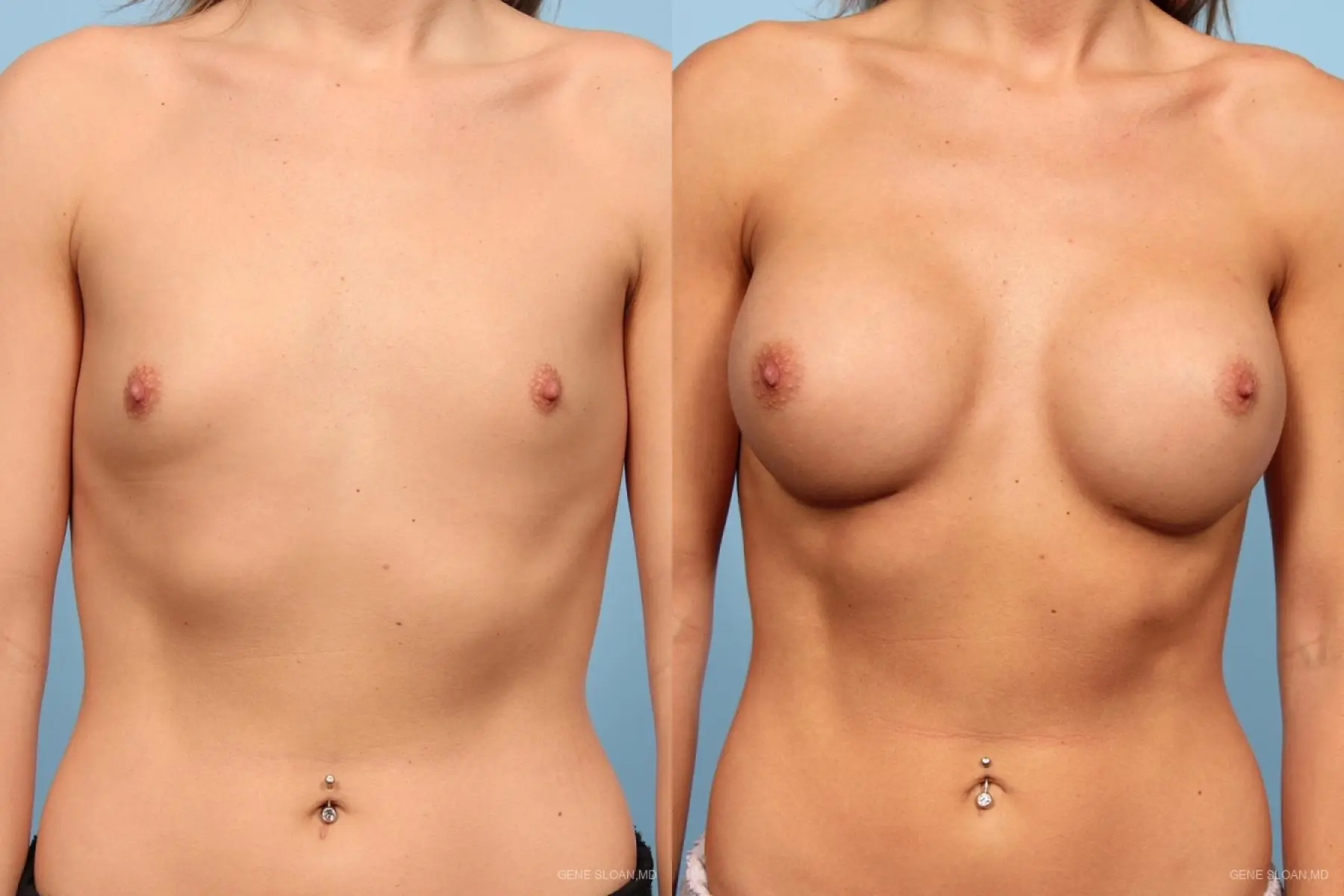 Breast Augmentation: Patient 15 - Before and After 1