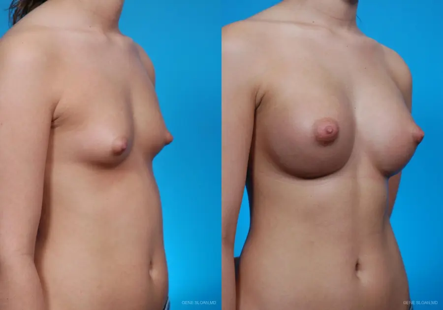Breast Augmentation: Patient 11 - Before and After 2