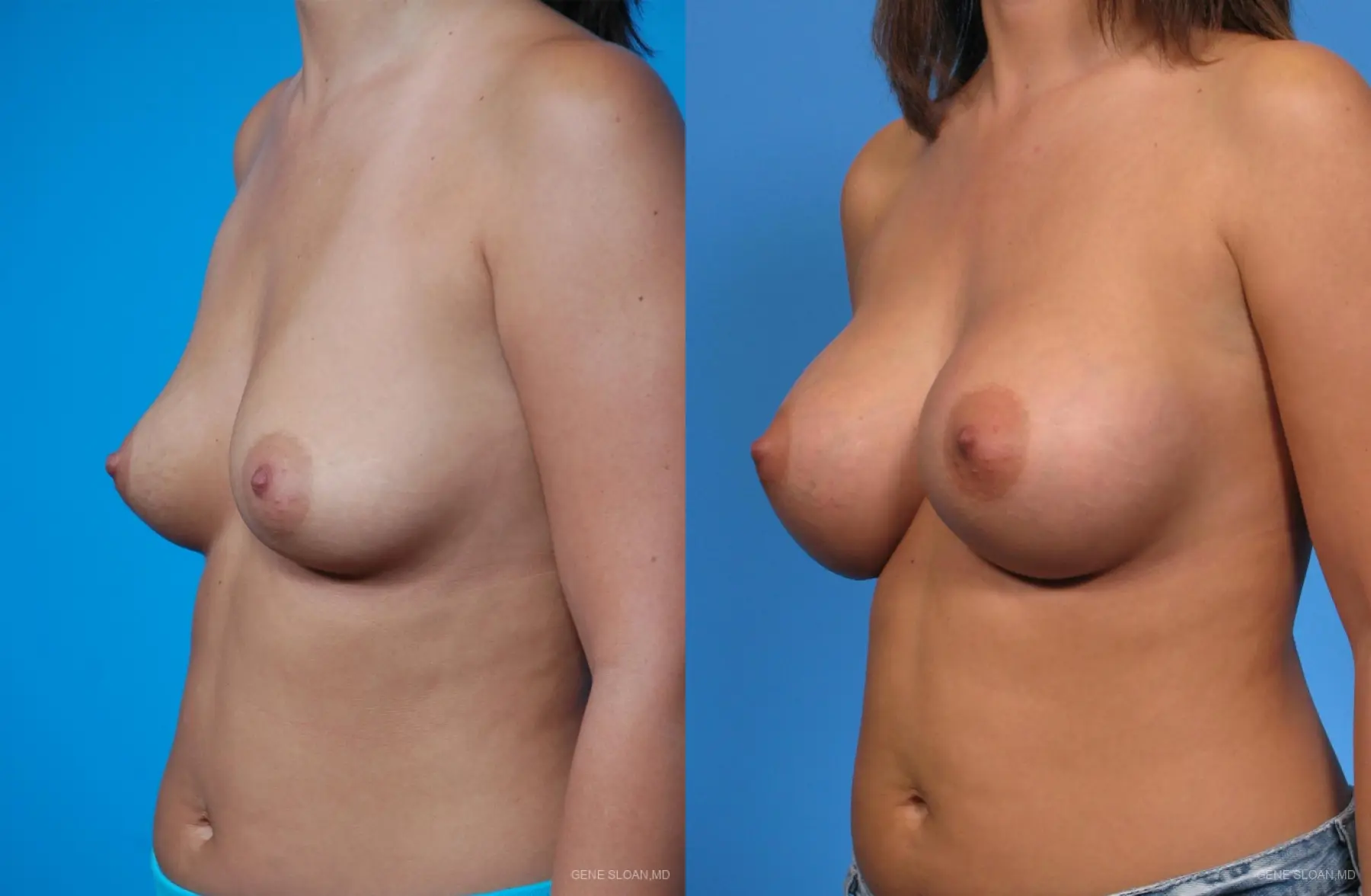 Breast Augmentation: Patient 1 - Before and After 2