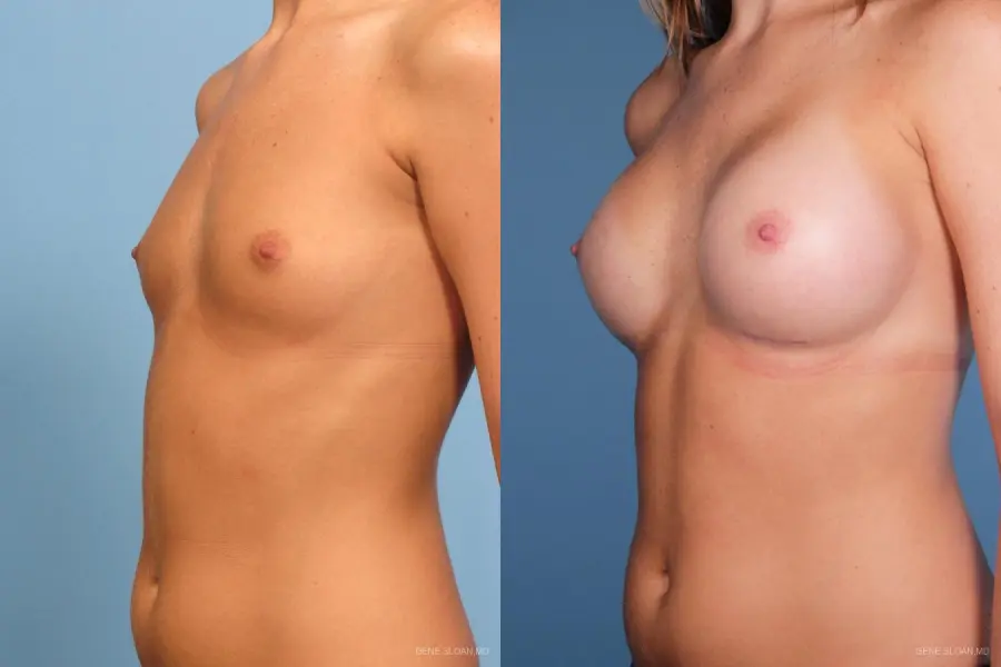 Breast Augmentation: Patient 14 - Before and After 2