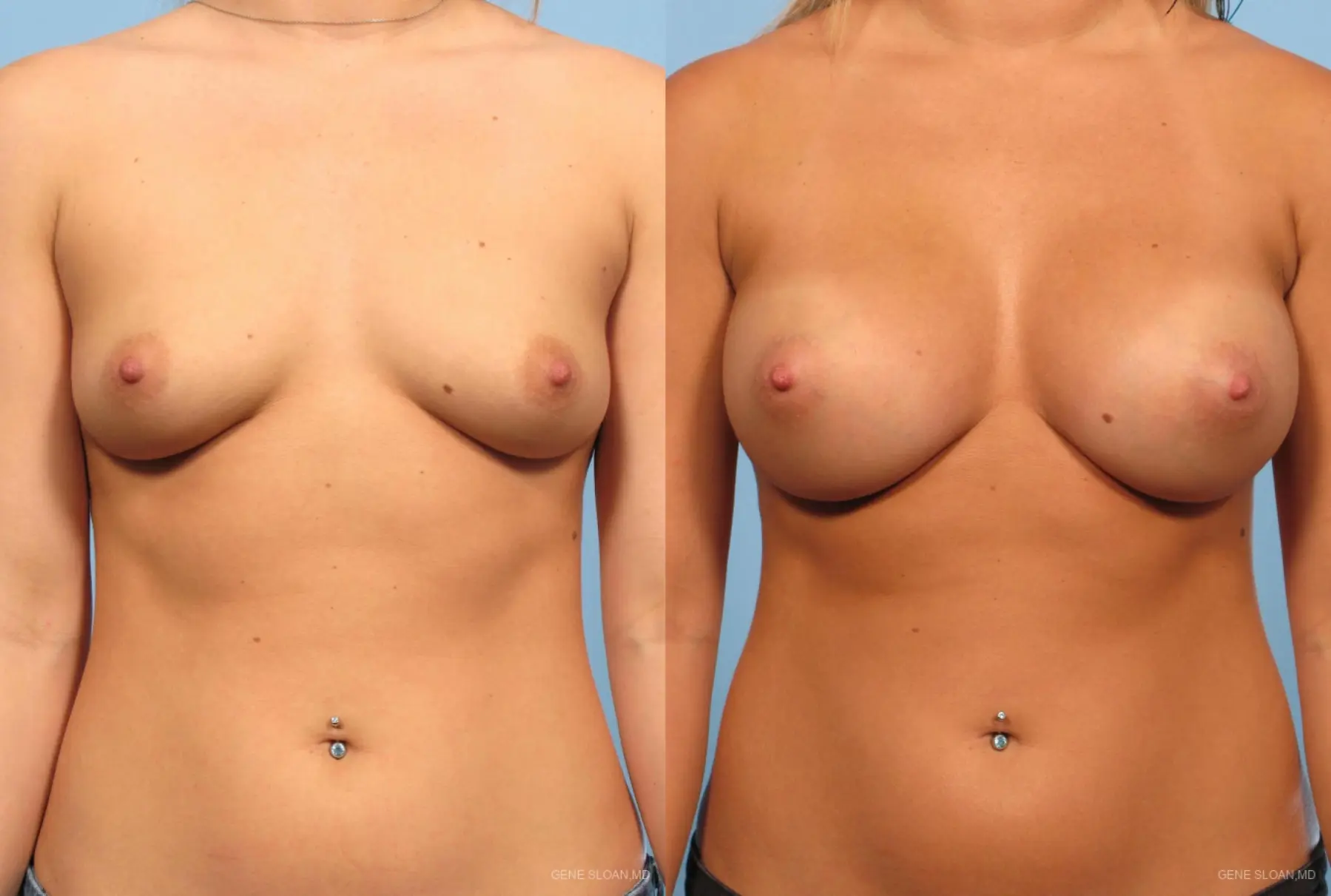 Breast Augmentation: Patient 3 - Before and After  
