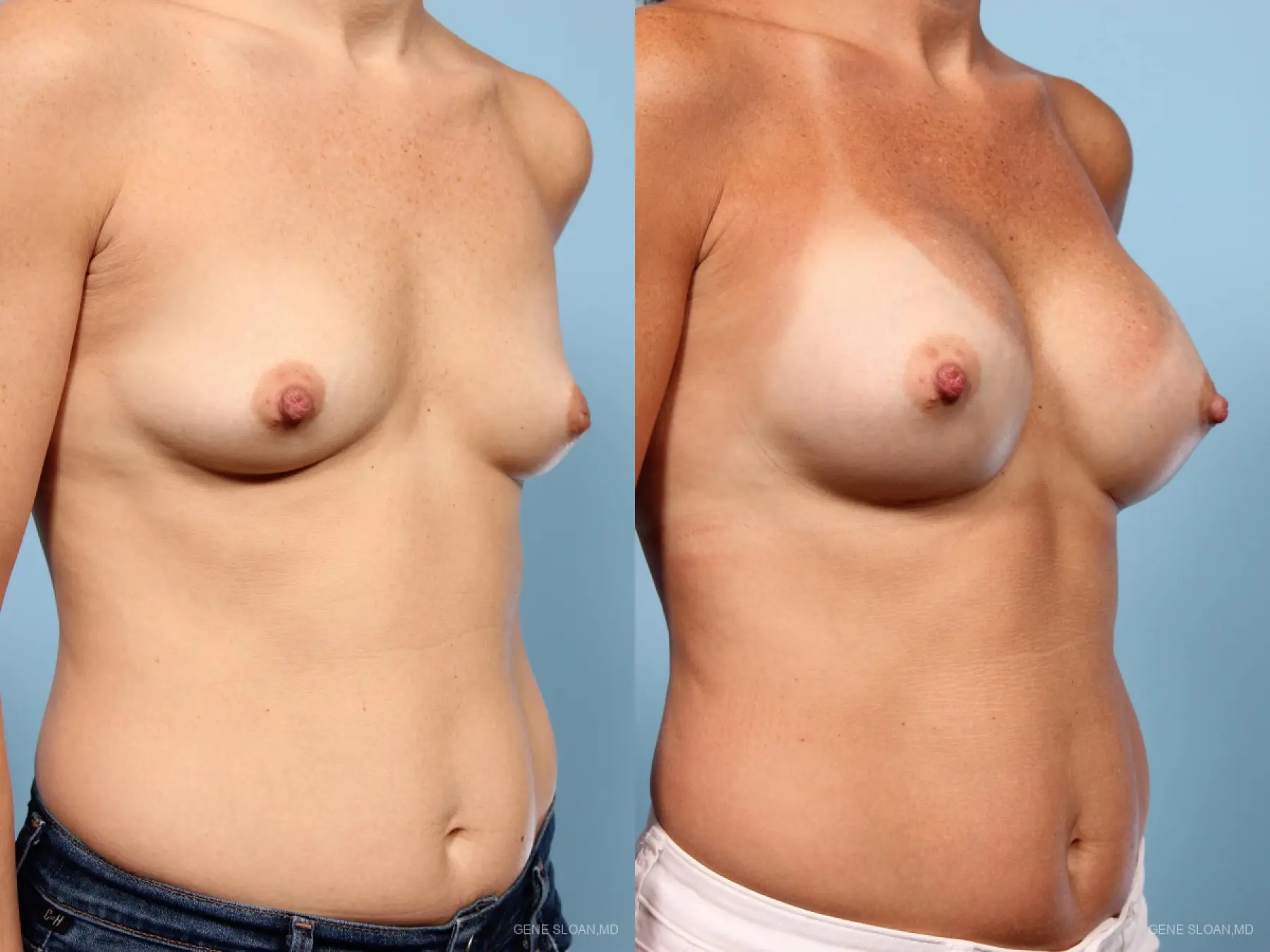 Breast Augmentation: Patient 7 - Before and After 2