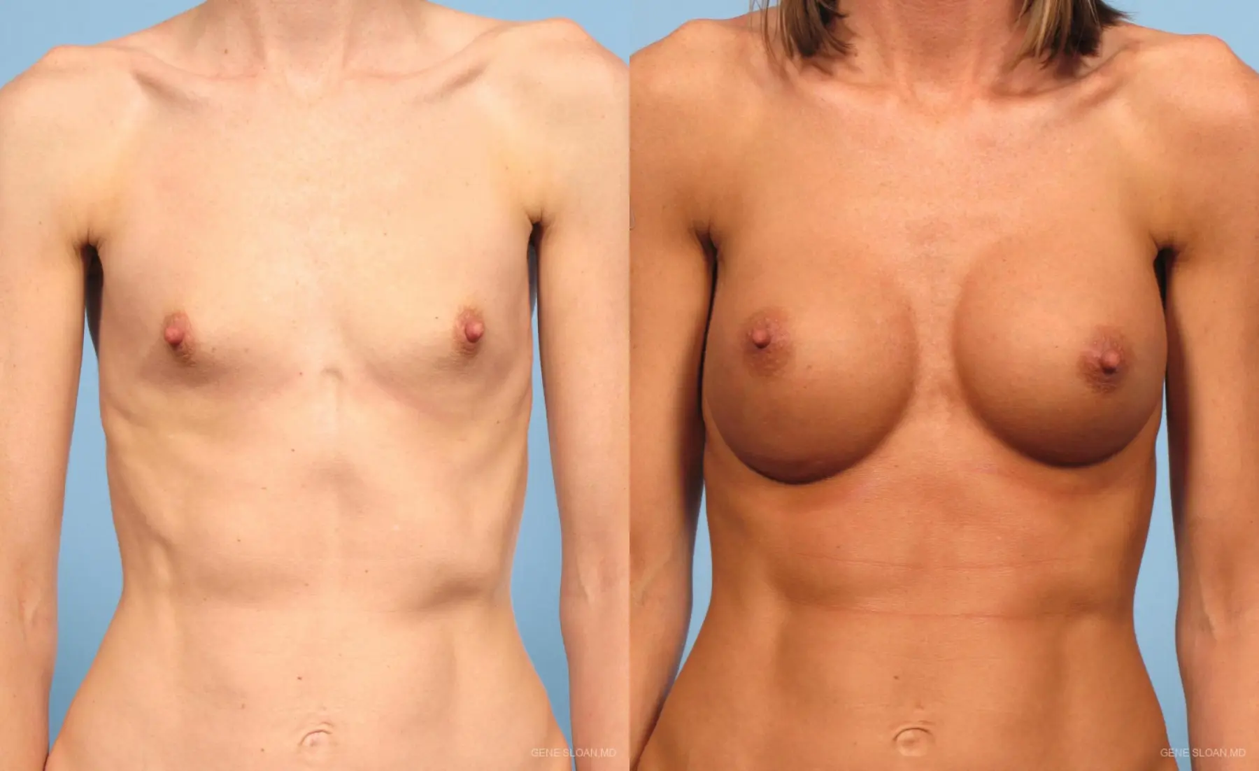 Breast Augmentation: Patient 9 - Before and After  