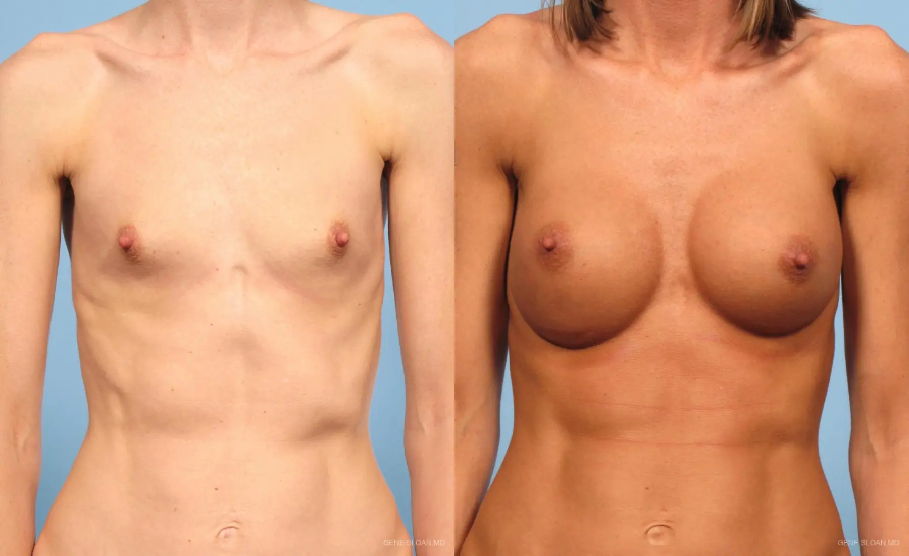Breast Augmentation: Patient 9 - Before and After