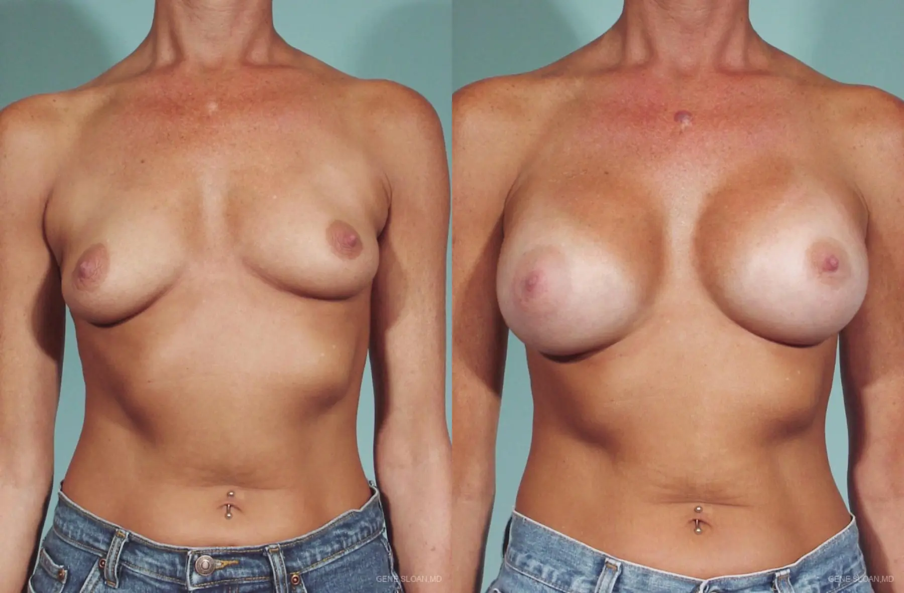 Breast Augmentation: Patient 21 - Before and After 1