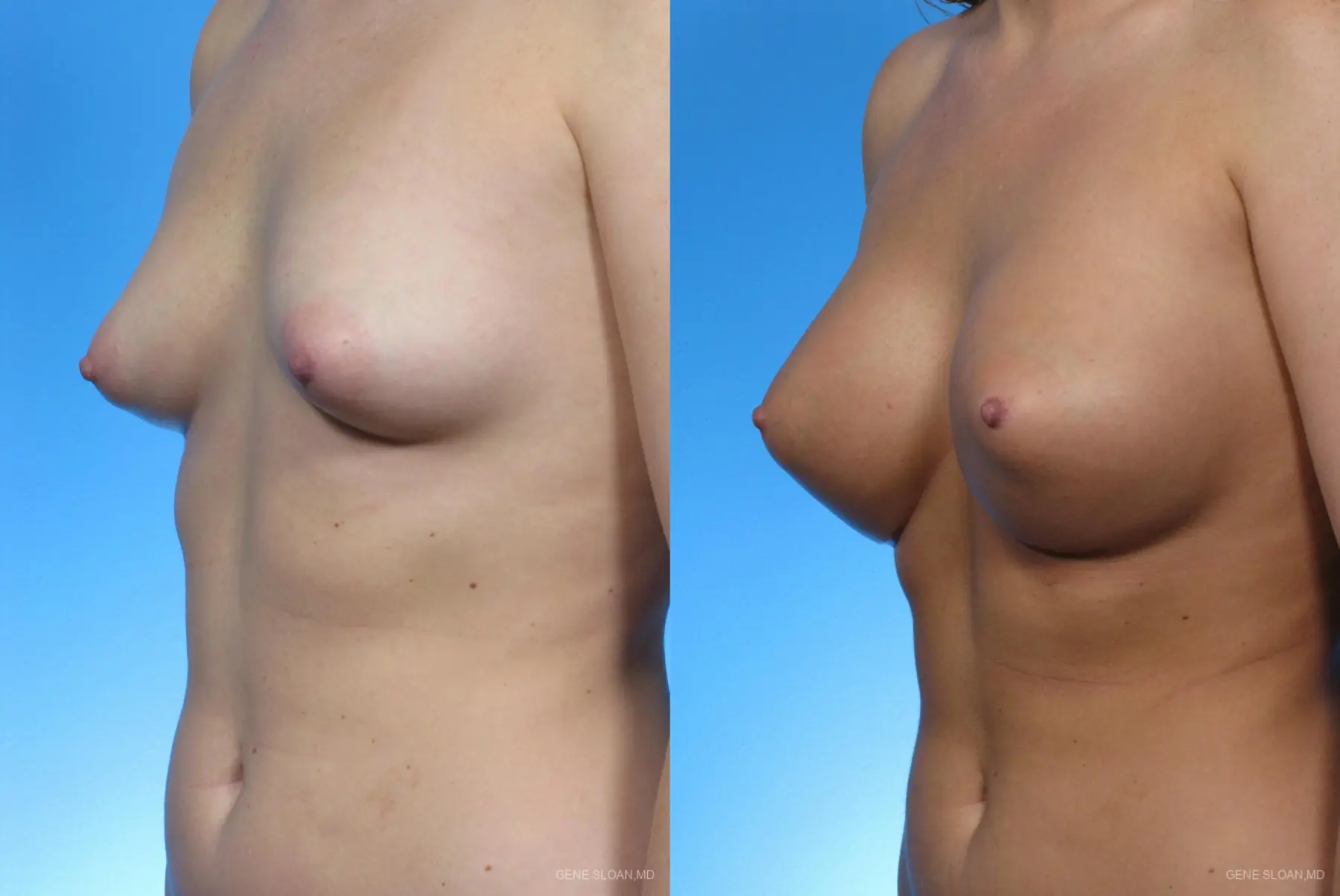 Breast Augmentation: Patient 5 - Before and After 2
