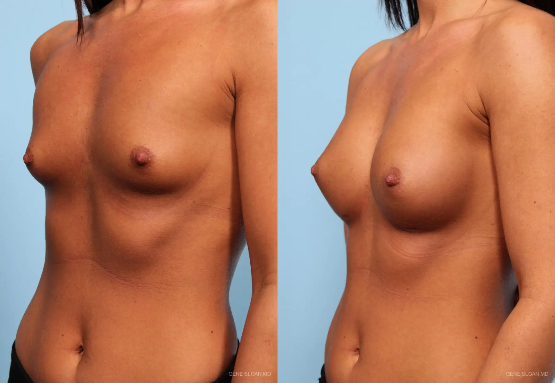Breast Augmentation: Patient 6 - Before and After 2