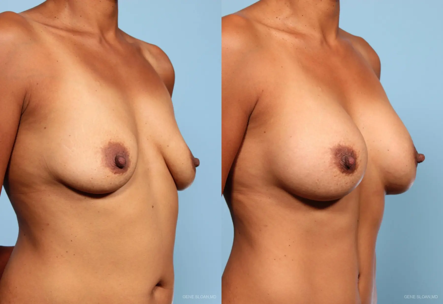 Breast Augmentation: Patient 10 - Before and After 2