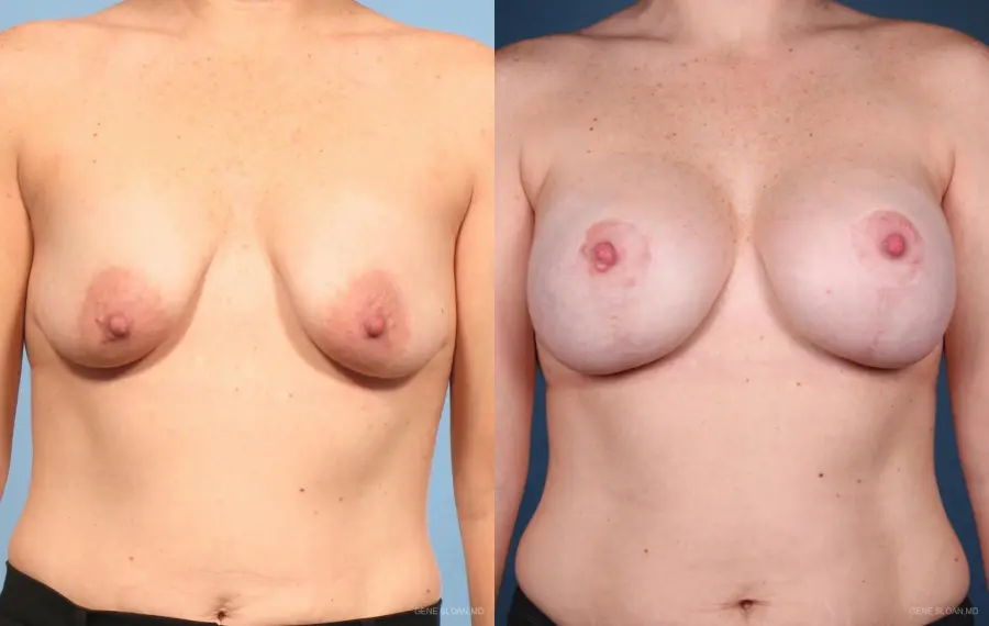 Breast Augmentation With Lift: Patient 6 - Before and After 1
